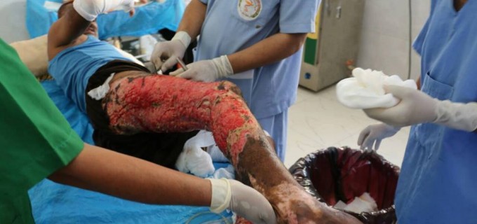 Centre des grands brûlés de Hodeidah — ATTENTION IMAGES CHOQUANTES