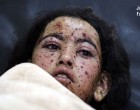 Une enfant yéménite sur un lit à l’hôpital après avoir été blessée dans les bombardements saoudiens !