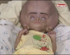 ATTENTION IMAGES CHOQUANTES !!! Des bébés yéménites avec des maladies rares causées par le régime saoudien qui bombarde sans cesse le Yémen avec des armes interdites !!!