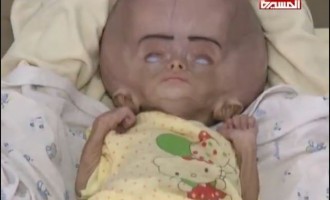 ATTENTION IMAGES CHOQUANTES !!! Des bébés yéménites avec des maladies rares causées par le régime saoudien qui bombarde sans cesse le Yémen avec des armes interdites !!!