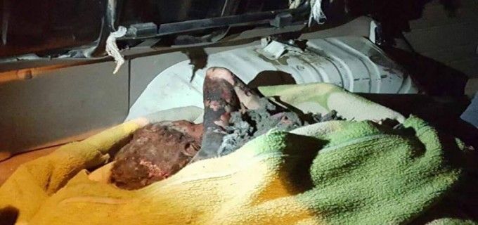 Découvrez en photos : Les dégâts produits par les bombes à sous-munitions saoudiennes sur les corps yéménites et en particulier les enfants