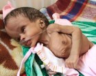 2 200 000 enfants au Yémen souffrent de malnutrition sévère