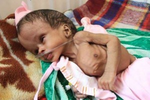 2 200 000 enfants au Yémen souffrent de malnutrition sévère1