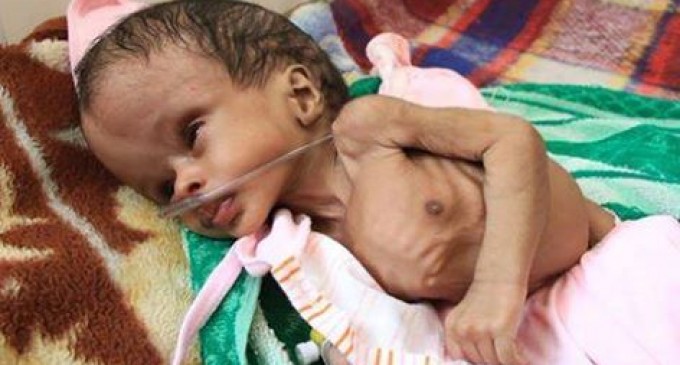 2 200 000 enfants au Yémen souffrent de malnutrition sévère
