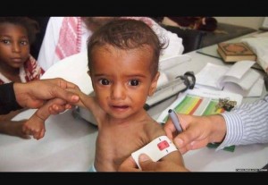 2 200 000 enfants au Yémen souffrent de malnutrition sévère2