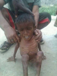 2 200 000 enfants au Yémen souffrent de malnutrition sévère3