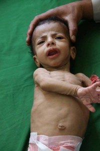 2 200 000 enfants au Yémen souffrent de malnutrition sévère4