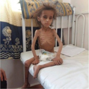 2 200 000 enfants au Yémen souffrent de malnutrition sévère5