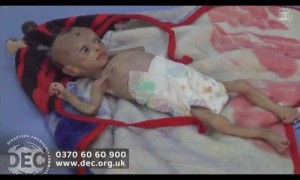 2 200 000 enfants au Yémen souffrent de malnutrition sévère6