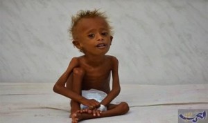Les enfants yéménites meurent de faim en raison de l'absence de nourriture et de médicaments à cause du blocus saoudien1