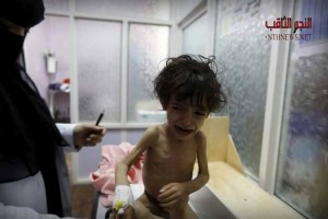 Les enfants yéménites meurent de faim en raison de l'absence de nourriture et de médicaments à cause du blocus saoudien2