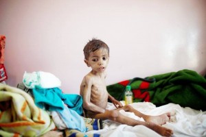 Les enfants yéménites meurent de faim en raison de l'absence de nourriture et de médicaments à cause du blocus saoudien3