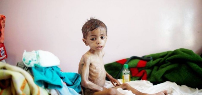 Les enfants yéménites meurent de faim en raison de l’absence de nourriture et de médicaments à cause du blocus saoudien