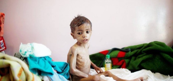 Les enfants yéménites meurent de faim en raison de l’absence de nourriture et de médicaments à cause du blocus saoudien