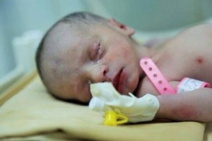 2 millions d'enfants souffrent de malnutrition dite « aiguë sévère » au Yémen1