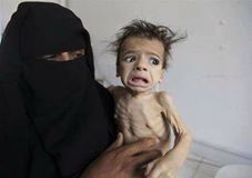 2 millions d'enfants souffrent de malnutrition dite « aiguë sévère » au Yémen4