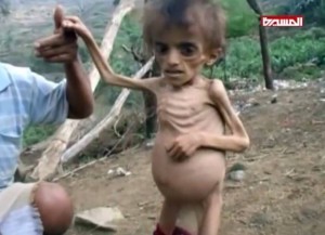 Le Yémen a longtemps lutté contre la malnutrition. Mais l'embargo de la coalition saoudienne a détruit les systèmes de distribution et a fait entrer le pays dans la famine.2