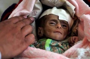 Le Yémen a longtemps lutté contre la malnutrition. Mais l'embargo de la coalition saoudienne a détruit les systèmes de distribution et a fait entrer le pays dans la famine.3