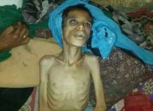 Le Yémen a longtemps lutté contre la malnutrition. Mais l'embargo de la coalition saoudienne a détruit les systèmes de distribution et a fait entrer le pays dans la famine.4