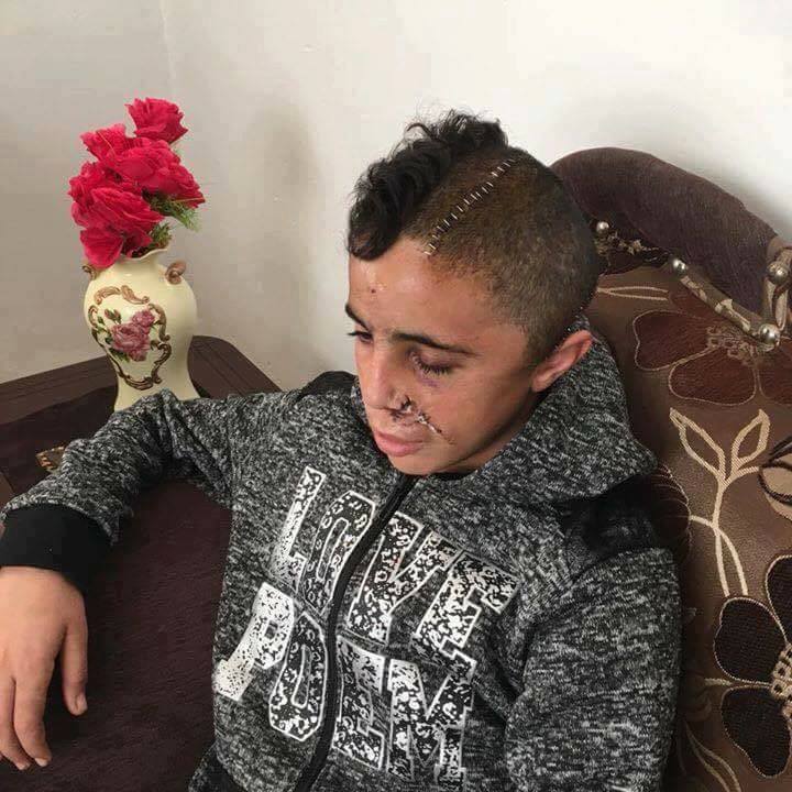 Mohamed Tamimi, le cousin de Ahed Tamimi, qui est toujours enfermé dans les prisons israéliennes, est rentré de l'hôpital hier après que les médecins ont retiré une balle de son cerveau