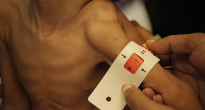 Près de 400 000 enfants souffrent d’une grave malnutrition aiguë, nécessitant un traitement vital au Yémen.