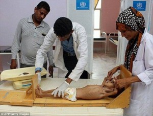 Des photos choquantes d'un enfant mal nourri montrent les effets brutaux de la guerre menée par la coalition Arabo-US contre le Yémen 1
