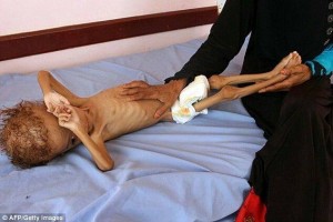 Des photos choquantes d'un enfant mal nourri montrent les effets brutaux de la guerre menée par la coalition Arabo-US contre le Yémen 2