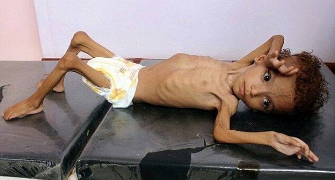 Des photos choquantes d’un enfant mal nourri montrent les effets brutaux de la guerre menée par la coalition Arabo-US contre le Yémen