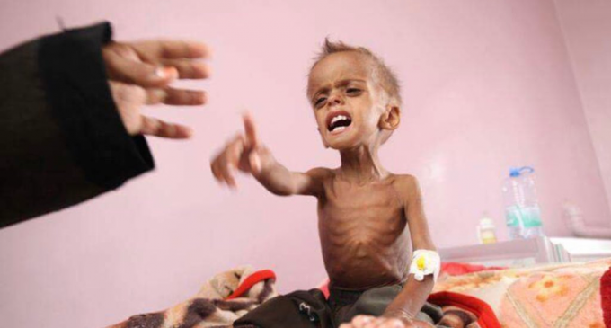 Il vient de mourir d’une grave malnutrition due à l’embargo de l’Arabie Saoudite sur le Yémen !