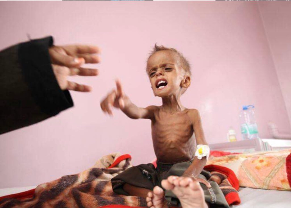 Il vient de mourir d'une grave malnutrition due à l'embargo de l'Arabie Saoudite sur le Yémen !1