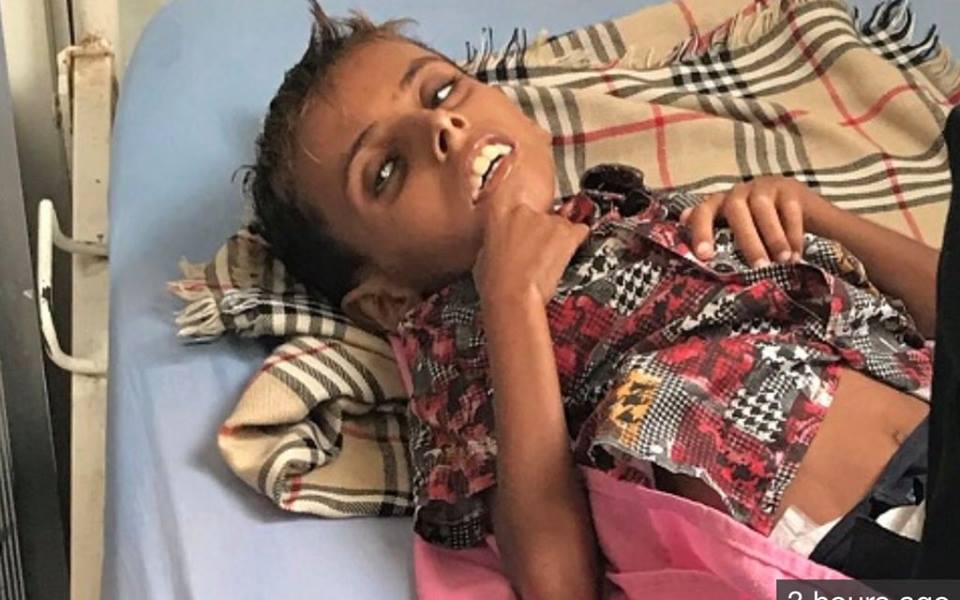 Il vient de mourir d'une grave malnutrition due à l'embargo de l'Arabie Saoudite sur le Yémen !2