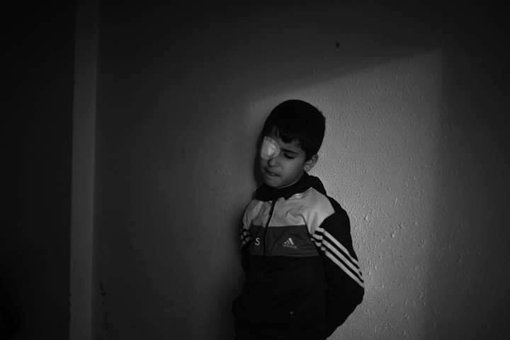 Le jeune Palestinien Mohammed Al-Najjar (12 ans) vit un grave choc psychologique après avoir perdu son œil droit par la balle d'un sniper israélien3